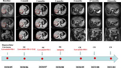 PD-1 combined with lenvatinib and TACE for the transformational treatment of hepatocellular carcinoma combined with portal vein tumor thrombus: a case report and literature review